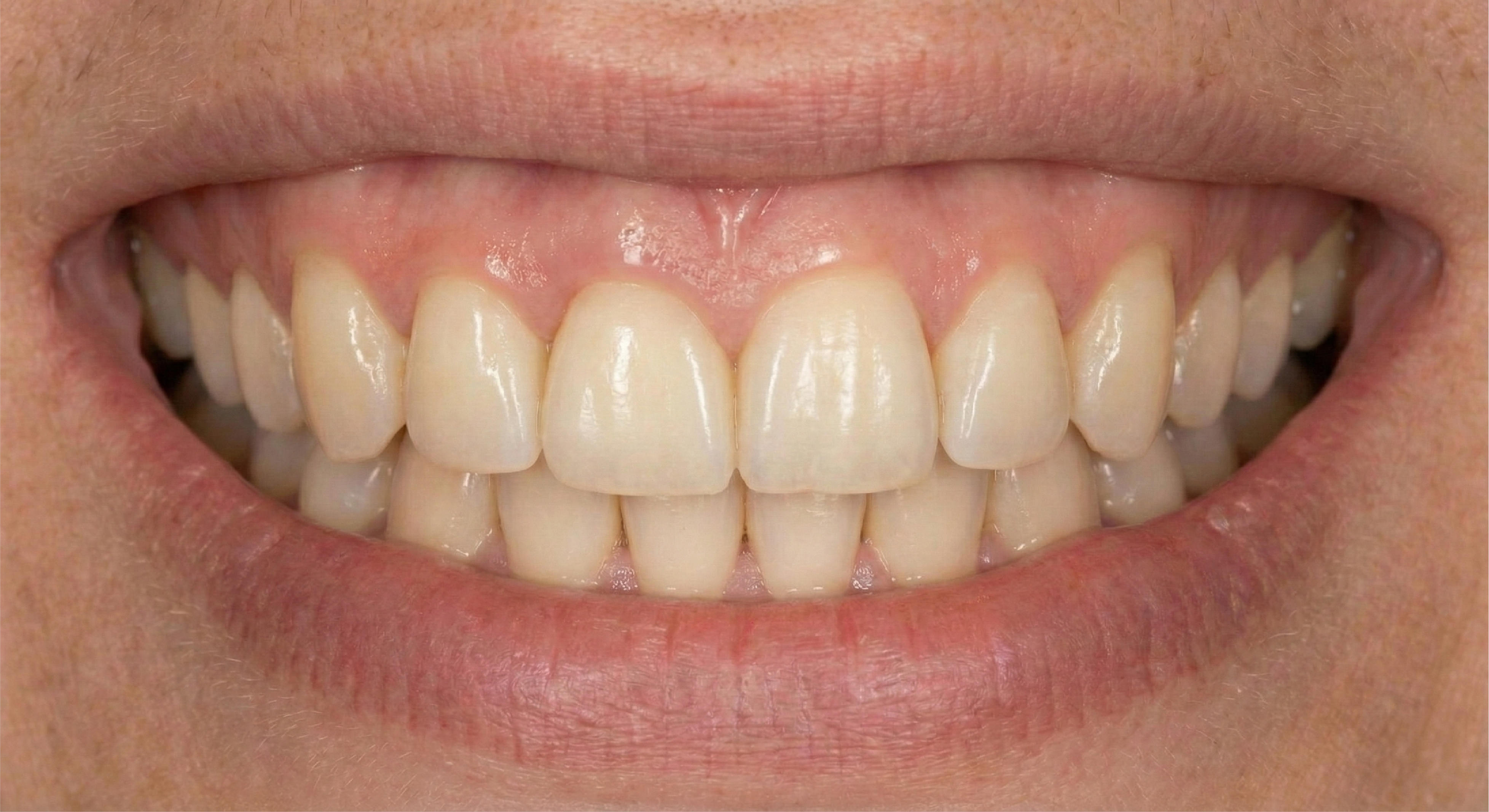 After — Zirconia Bridge